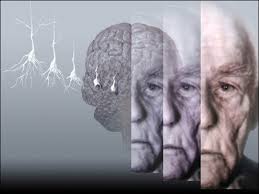alzheimer bis