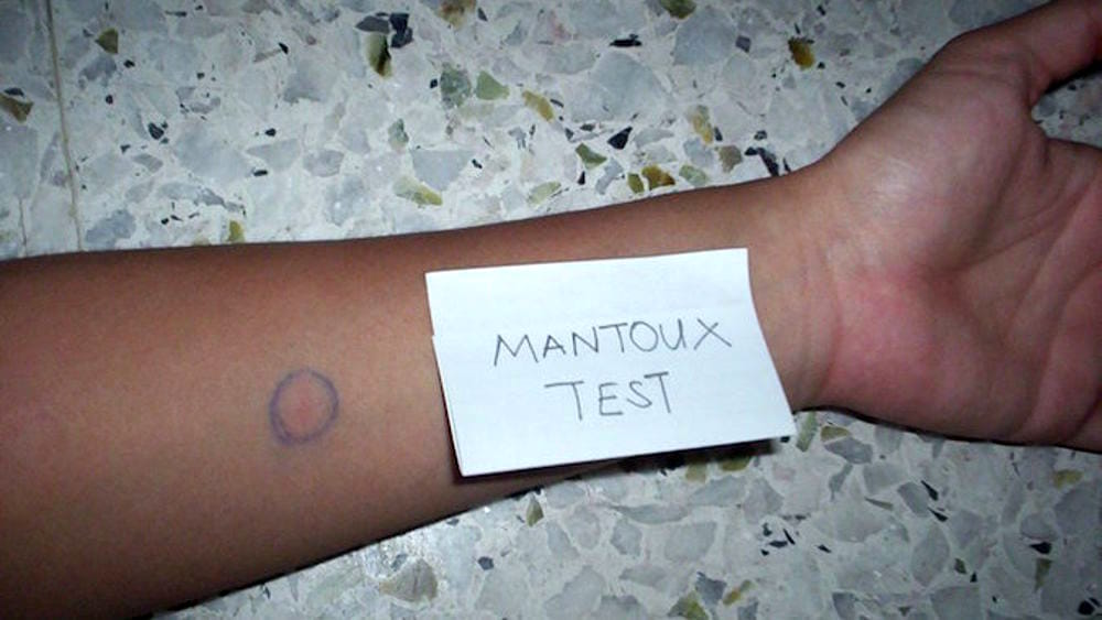 test-mantoux-tubercolosi-2