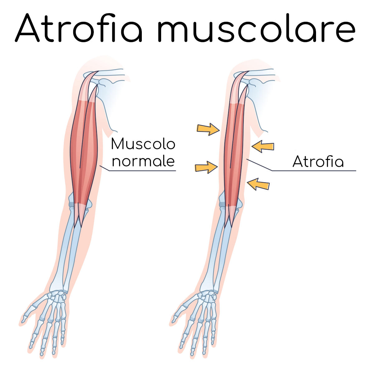 atrofia-muscolare